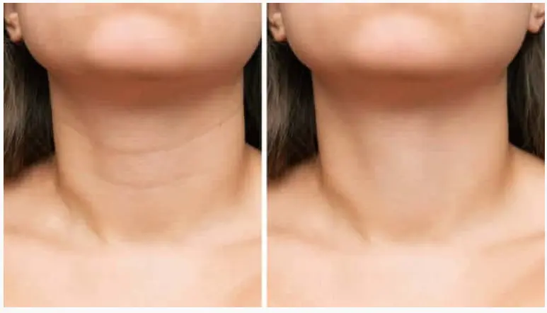 Arrugas De Cuello
