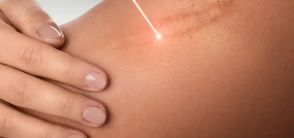 Endolift Laser Cicatriz