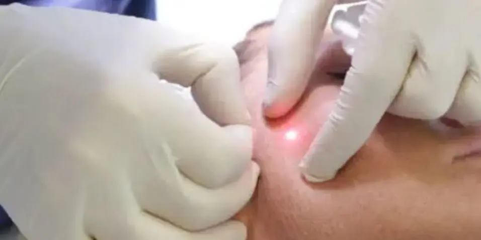 Endolift Facial Tercio Medio Y Mandíbula