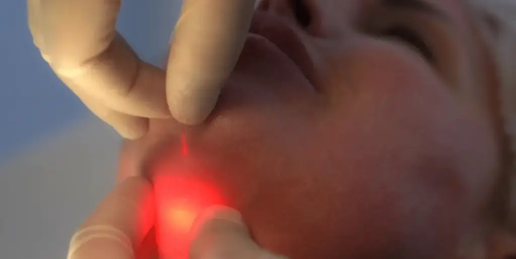 Endolift Full Face