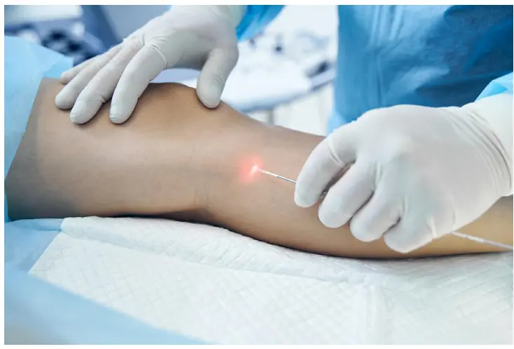 Endolift Corporal