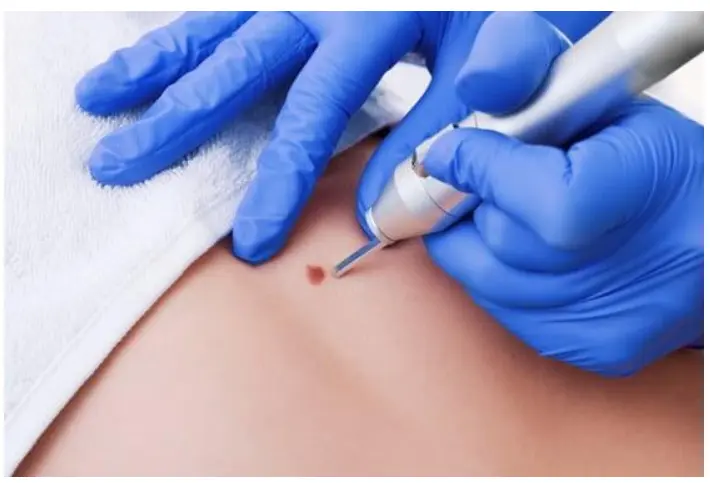 Eliminación De Verrugas