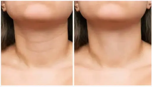 Arrugas De Cuello