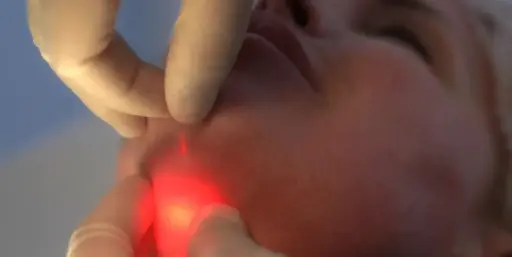 Endolift Full Face