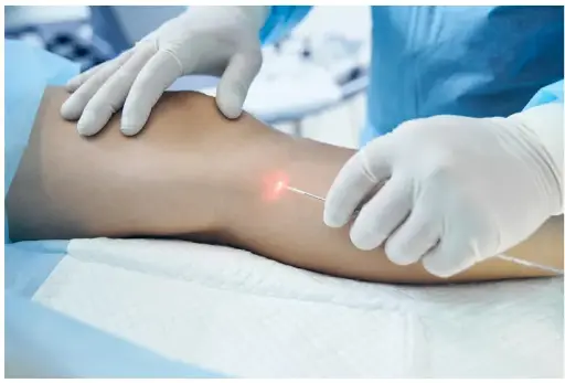 Endolift Corporal